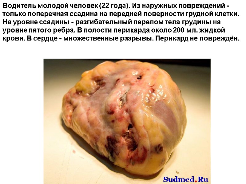 Водитель молодой человек (22 года). Из наружных повреждений - только поперечная ссадина на передней